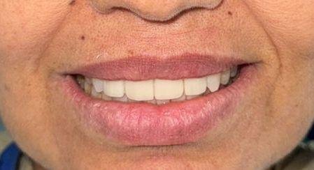 Laminates Veneers Gallery 3